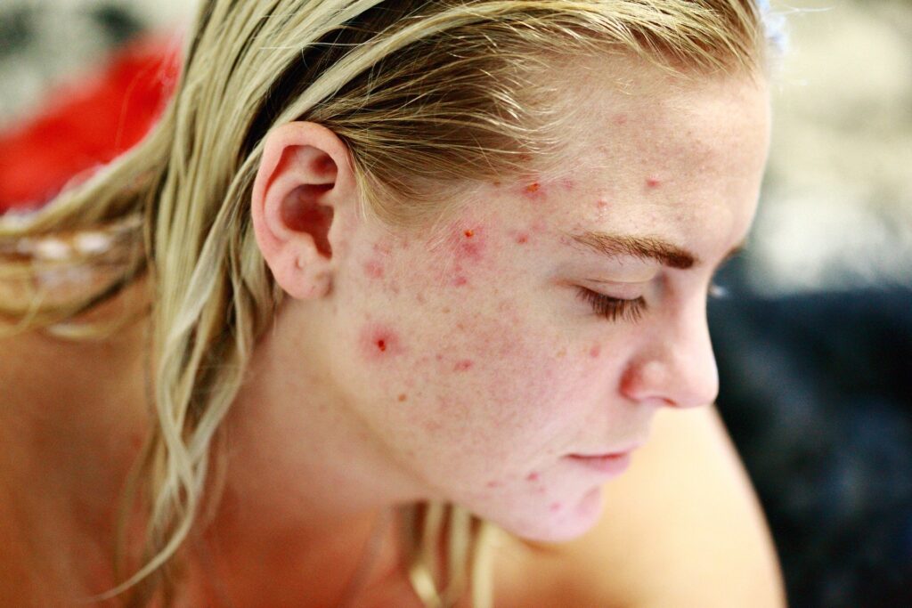 Benefici dell'olio essenziale di patchouli sull'acne