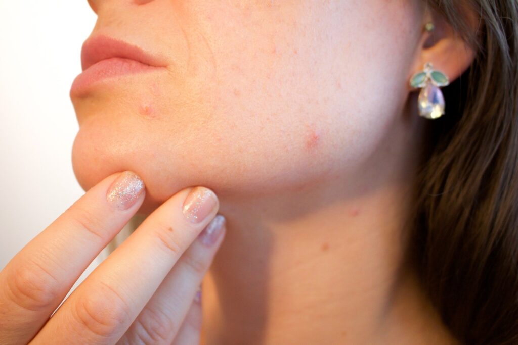 Benefici dell'olio essenziale di geranio su acne e piaghe